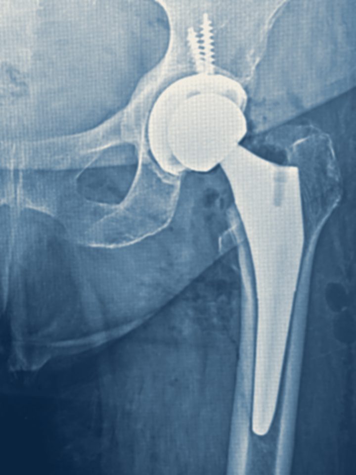 Radiografía anteroposterior de pelvis con una artroplastia total de cadera: cótilo fijado con dos tornillos, cabeza protésica y vástago femoral en el canal medular.